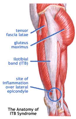 Runners Knee (also known as) ITB Syndrome - Do You Have It and How